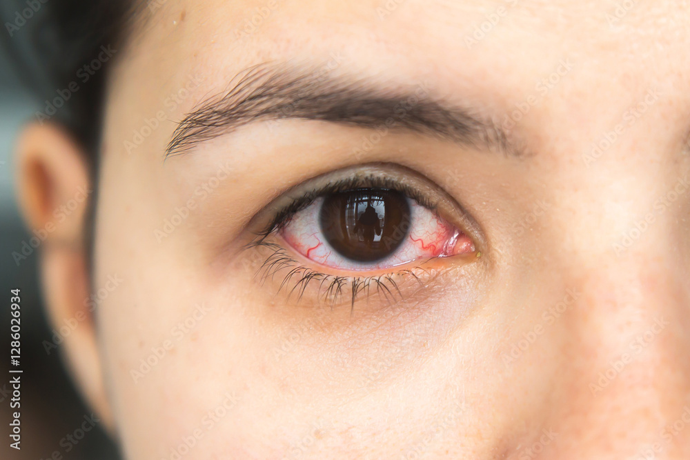 Obraz premium Red and inflamed eye with visible blood vessels, close-up of an irritated human eye, symptoms of conjunctivitis or eye infection, medical condition, ophthalmology, eye health