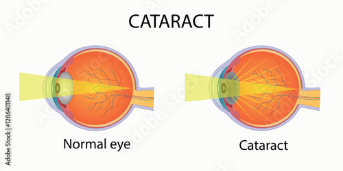 Cataract, visual disorder, image of normal vision and vision with cataract.