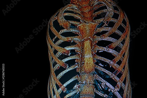Obraz na płótnie Medical themes: Right chest CAT- SCAN of patient with broken ribs w salonie