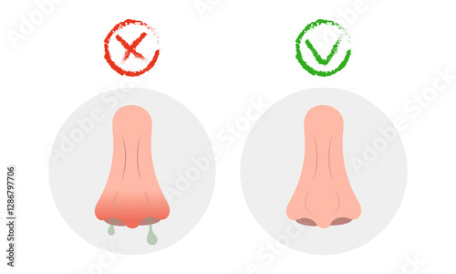 Nose infection virus or allergy symptoms with runny nose and healthy nose. Cold and flu sneeze treatment