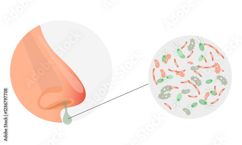 Nose infection virus or allergy symptoms with runny nose and zoom bacterials. Cold and flu sneeze treatment
