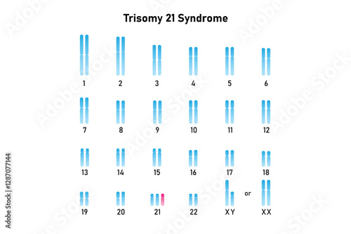 Trisomy 21 Syndrome Science Design. Vector Illustration.