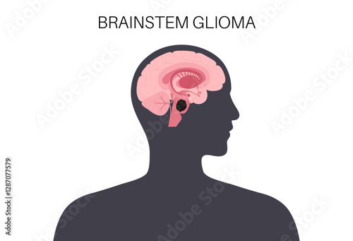 Brainstem glioma cancer