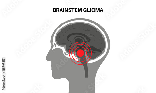 Brainstem glioma cancer