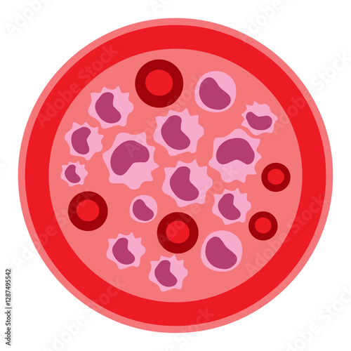 lymphoma