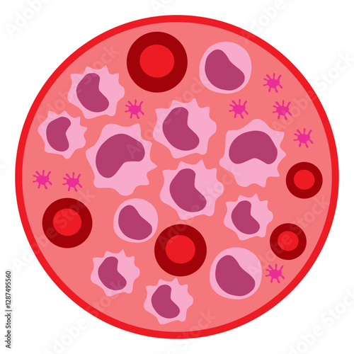 lymphoma
