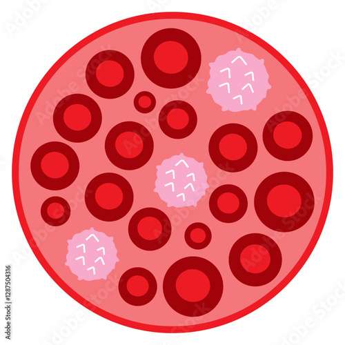 polycythemia vera