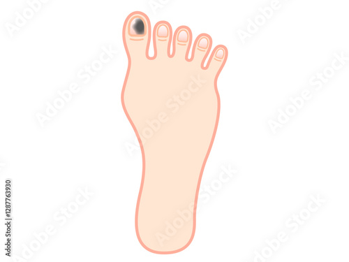 爪下血腫になった足の指のイラスト素材