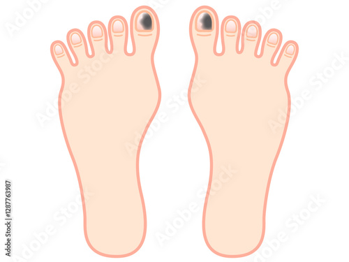 爪下血腫になった足の指のイラスト素材2