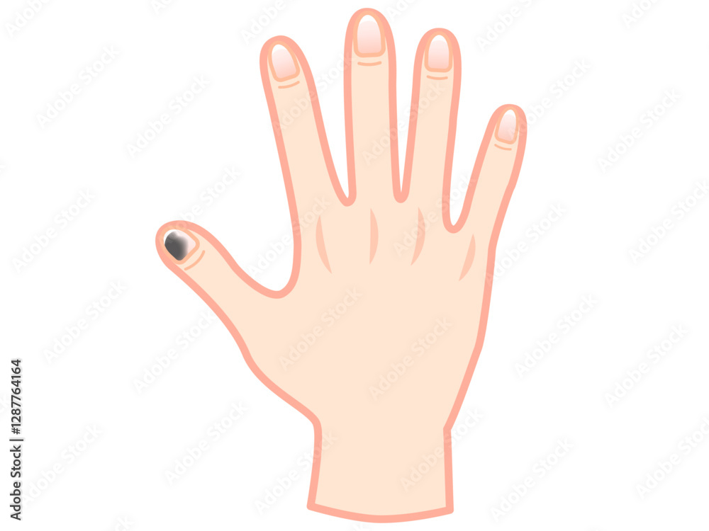 Obraz premium 爪下血腫で内出血した手のイラスト素材2