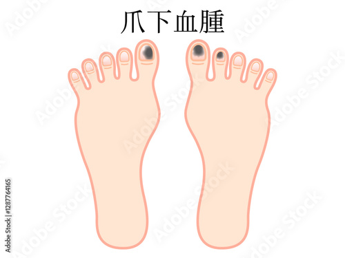 爪下血腫になった足の指のイラスト素材3