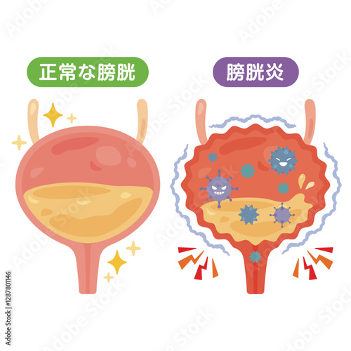 正常な膀胱と膀胱炎のイラスト