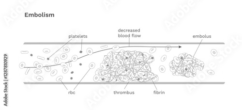 Embolism medical chart outline. Blood clot movement in the blood vessel 