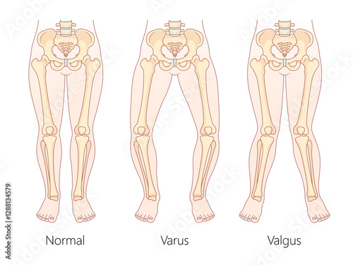 differences between normal leg alignment, varus bowlegged, and valgus knock-knees conditions with skeletal structure diagram hand drawn raster illustration. Medical science educational illustration