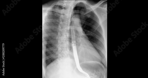 Fluoroscopic footage of a barium swallow test showing real-time esophageal function, used to assess dysphagia, GERD, and structural abnormalities.