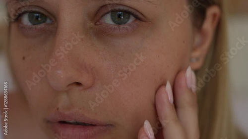 Close-up of a young woman's face showing skin with pigmentation spots caused by sun exposure, hormonal changes, aging, and inflammation. Skincare awareness and treatment options for hyperpigmentation