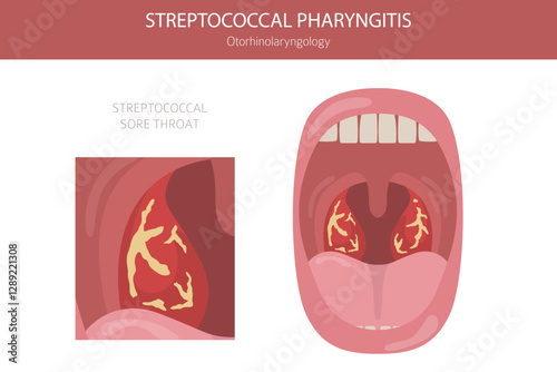 Subglottic Stenosis diseases. Pulmonology, otolaryngology. Medical infographic design. Vector illustration