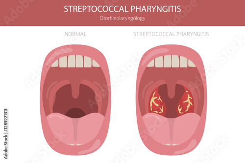 Subglottic Stenosis diseases. Pulmonology, otolaryngology. Medical infographic design. Vector illustration