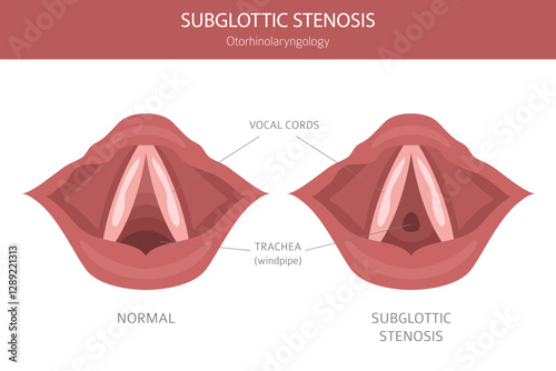 Subglottic Stenosis diseases. Pulmonology, otolaryngology. Medical infographic design. Vector illustration