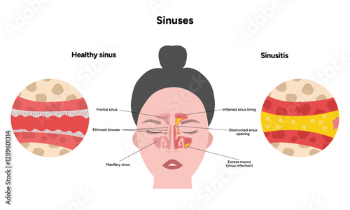 Sinuses anatomy healthy sinus and sinusitis. Nose nasal anatomy. Inflammation Nasal Cavity