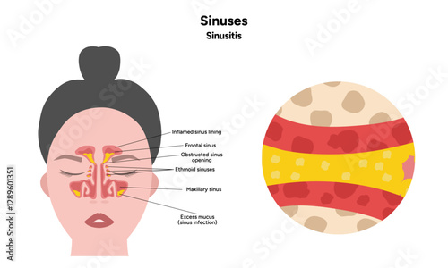 Sinuses anatomy sinusitis. Nose nasal anatomy. Inflammation Nasal Cavity