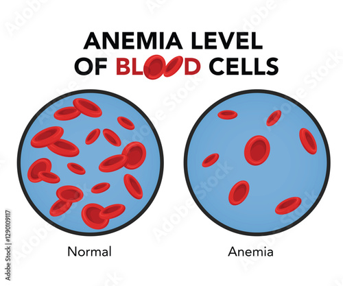 Anemia level of blood cells stock illustration