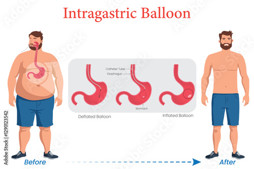 Intragastric Balloon Diagram Illustration Showing Weight Loss in an Obese Man After Use