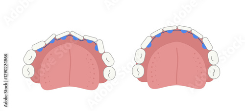 Lingual braces in the mouth at the inner surface of tooth before and after chart. Medical simple flat geometric picture.
