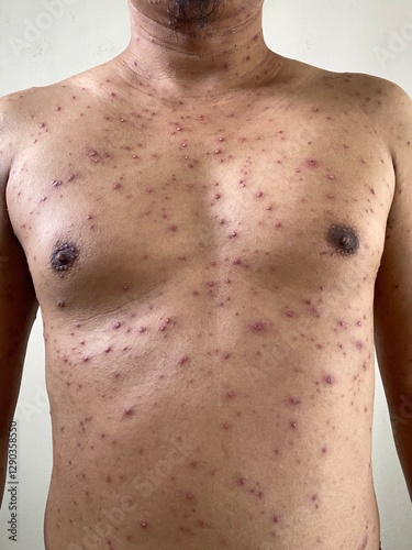 Obraz na płótnie Adult man's chest and abdomen with Pustular Rash and Scabs of Smallpox Monkeypox