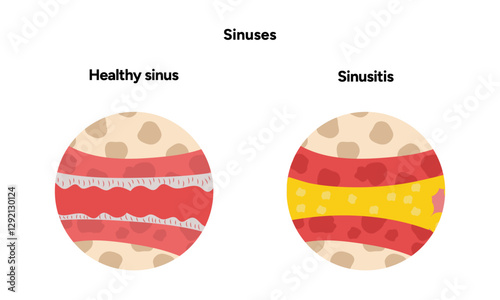 Sinuses anatomy healthy sinus and sinusitis. Nose nasal anatomy. Inflammation Nasal Cavity