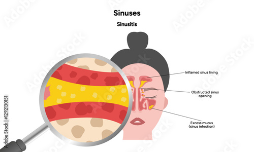 Sinuses anatomy sinusitis. Nose nasal anatomy. Inflammation Nasal Cavity
