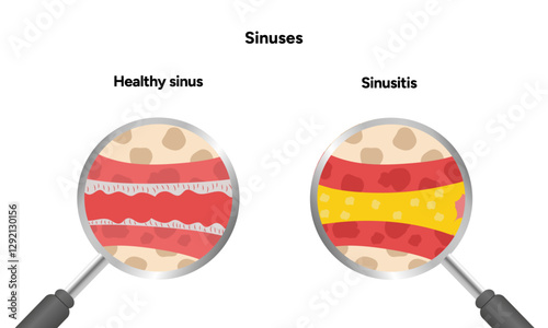 Sinuses anatomy healthy sinus and sinusitis. Nose nasal anatomy. Inflammation Nasal Cavity