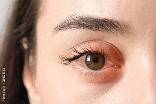 Conjunctivitis. Young woman with infected eye, closeup