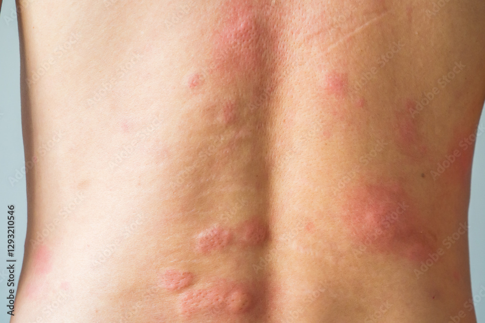 Fototapeta premium Young asian man itching and scratching on his back from allergic itchy dry skin eczema dermatitis insect bites