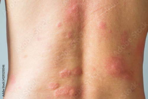 Young asian man itching and scratching on his back from allergic itchy dry skin eczema dermatitis insect bites