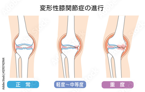 変形性膝関節症の進行を表したイラスト