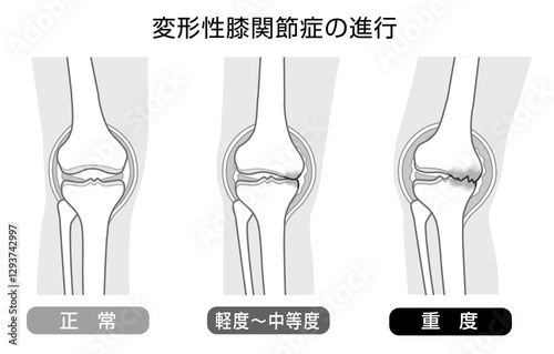 変形性膝関節症の進行を表したモノトーンのイラスト photo