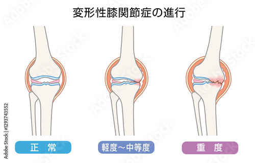 変形性膝関節症の進行を表したイラスト