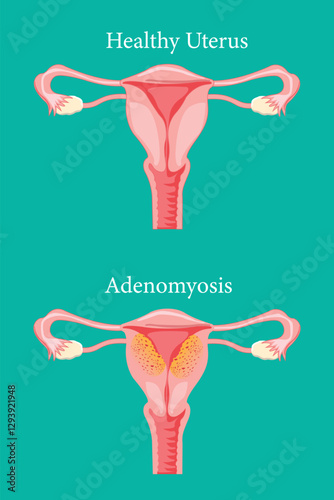 comparison of  adenomyosis symptoms versus a healthy uterus. medical illustration.