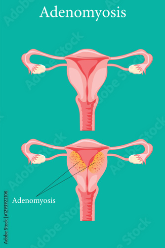 camparison of adenomyosis symptoms versus a healthy uterus. medical illustration. eps 10