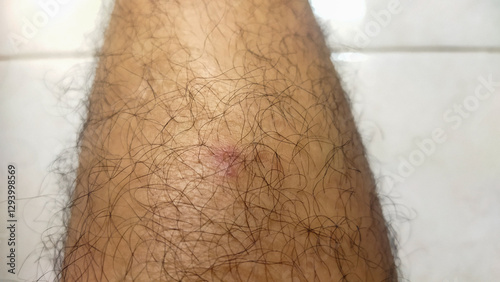 Obraz na płótnie An intimate macro photograph displaying a red bump skin irritation on a hairy surface, suggesting a minor infection or irritation