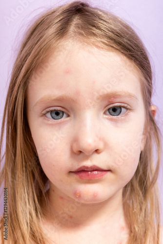 Fotografie Varicella virus or Chickenpox bubble rash on child