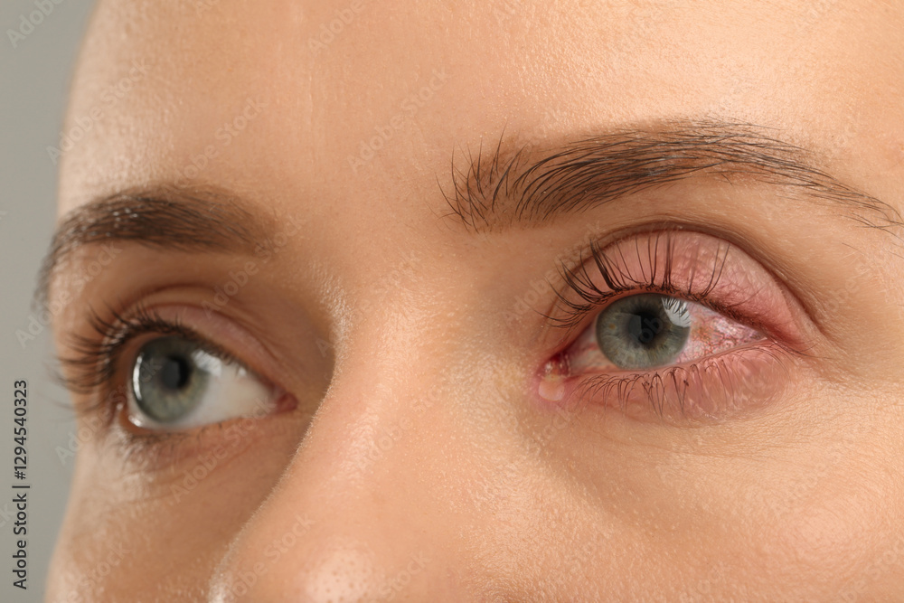 Naklejka premium Conjunctivitis. Young woman with infected eye, closeup