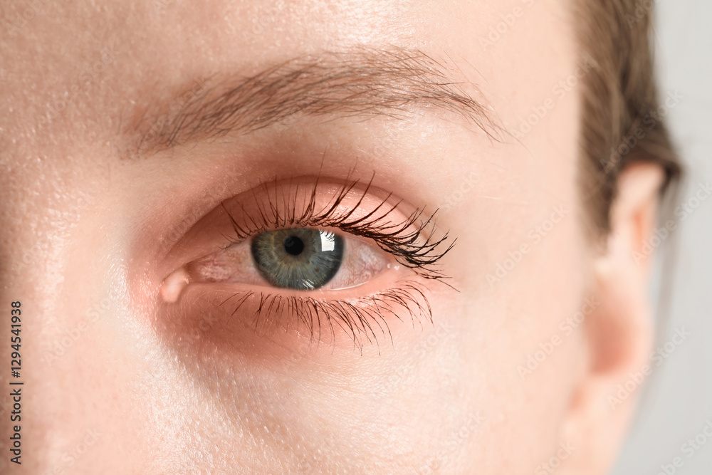 Fototapeta premium Conjunctivitis. Young woman with infected eye, closeup