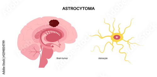 Astrocytoma brain cancer