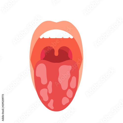 oral candidiasis