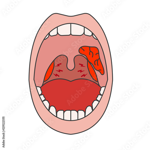 tonsil
