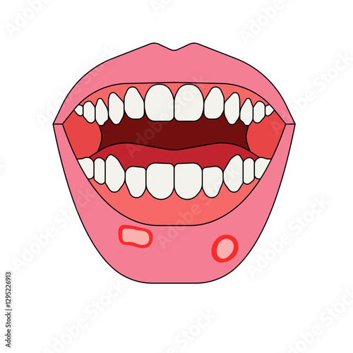 oral ulcer