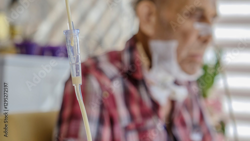 An elderly man with cancer, being fed with medical nutritional formula through a tube in his nose, sits sadly on the balcony of his home