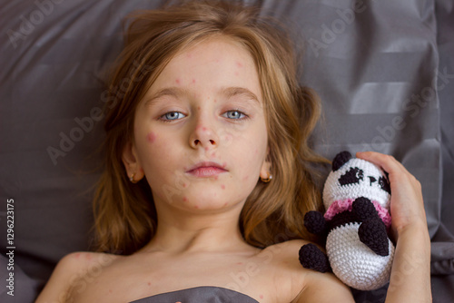 Little sad girl with a rash on her face and body lies in bed with a toy, chickenpox or measles virus in children	